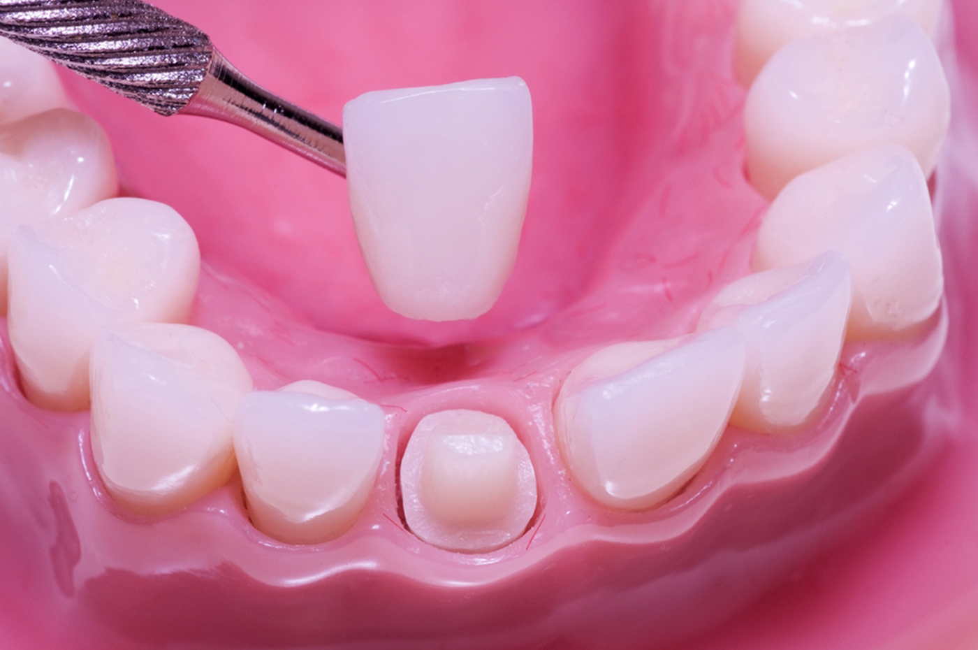 Sabes qué tipos de Coronas Dentales puedes encontrarte actualmente?