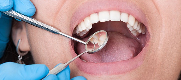Caries Dentales: Más Allá de una Simple Molestia